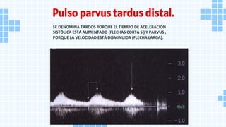 Pulso parvus tardus distal.
SE DENOMINA TARDOS PORQUE EL TIEMPO DE ACELERACIÓN
SISTÓLICA ESTÁ AUMENTADO (FLECHAS CORTA S ) Y PARVUS ,
PORQUE LA VELOCIDAD ESTÁ DISMINUIDA (FLECHA LARGA).
 