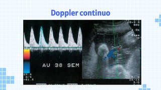 Doppler continuo
 