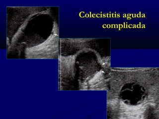 Colecistitis agudaColecistitis aguda
complicadacomplicada
 