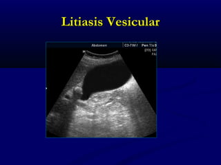 Litiasis VesicularLitiasis Vesicular
 