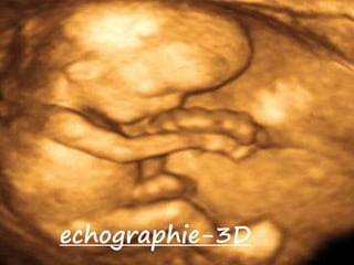 echographie-3D
 