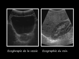 Ecoghrapie de la vessie Ecographie du rein
 