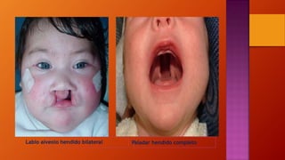 Labio alveolo hendido bilateral Paladar hendido completo
 