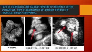 Para el diagnóstico del paladar hendido se necesitan cortes
transversos. Para el diagnóstico del paladar hendido se
necesitan cortes transversos.
 