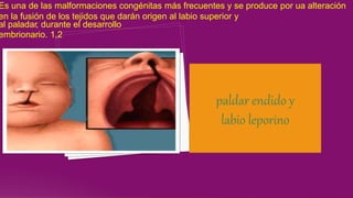 Es una de las malformaciones congénitas más frecuentes y se produce por ua alteración
en la fusión de los tejidos que darán origen al labio superior y
al paladar, durante el desarrollo
embrionario. 1,2
paldar endido y
labio leporino
 