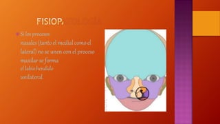  Si los procesos
nasales (tantoel medial comoel
lateral)no se unen con el proceso
maxilar se forma
el labio hendido
unilateral.
 