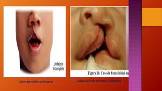 Labio hendido unilateral Labio-alveolo hendido unilateral
 