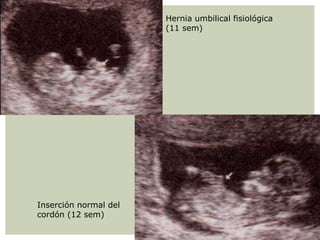 Hernia umbilical fisiológica
(11 sem)
Inserción normal del
cordón (12 sem)
 