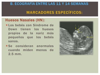 Huesos Nasales (HN):
 Los bebés con Síndrome de
Down tienen los huesos
propios de la nariz más
pequeños que los bebés
sanos.
 Se consideran anormales
cuando miden menos de
2.5 mm.
MARCADORES ESPECÍFICOS:
 