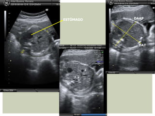 DAAP
DAT
ESTÓMAGO
 