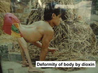 Deformity of body by dioxin 