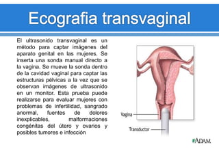 El ultrasonido transvaginal es un
método para captar imágenes del
aparato genital en las mujeres. Se
inserta una sonda manual directo a
la vagina. Se mueve la sonda dentro
de la cavidad vaginal para captar las
estructuras pélvicas a la vez que se
observan imágenes de ultrasonido
en un monitor. Esta prueba puede
realizarse para evaluar mujeres con
problemas de infertilidad, sangrado
anormal, fuentes de dolores
inexplicables, malformaciones
congénitas del útero y ovarios y
posibles tumores e infección
 
