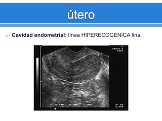  Cavidad endometrial: línea HIPERECOGENICA fina.
Fase menstrual normal
 