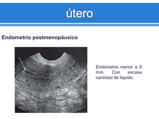 Endometrio postmenopáusico
Endometrio menor a 9
mm. Con escasa
cantidad de liquido.
 