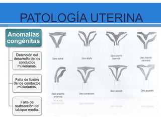 PATOLOGÍA UTERINA
Anomalías
congénitas
Detención del
desarrollo de los
conductos
müllerianos.
Falta de fusión
de los conductos
müllerianos.
Falta de
reabsorción del
tabique medio.
 