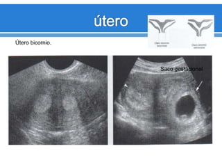 Útero bicornio.
Saco gestacional
 