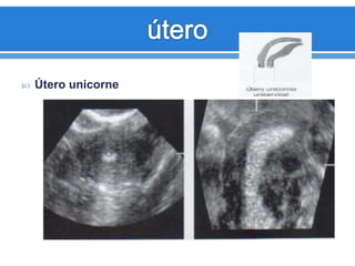  Útero unicorne
 