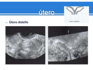 Útero didelfo
 