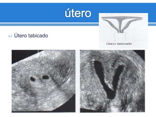  Útero tabicado
 