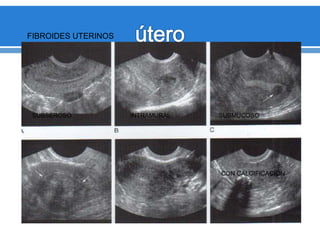 FIBROIDES UTERINOS
SUBSEROSO INTRAMURAL SUBMUCOSO
CON CALCIFICACION
 
