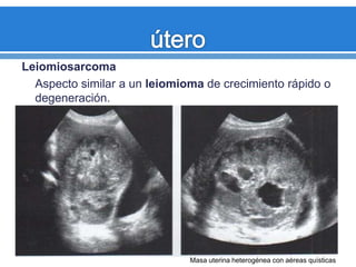 Leiomiosarcoma
Aspecto similar a un leiomioma de crecimiento rápido o
degeneración.
Masa uterina heterogénea con aéreas quísticas
 