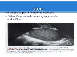 Hidrometrocolpos y hematometracolpos
 Distención acentuada de la vagina y cavidad
endomEtrial.
 