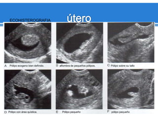 ECOHISTEROGRAFIA
Pólipo ecogeno bien definido. alfombra de pequeños pólipos. Pólipo sobre su tallo
Pólipo con área quística. Pólipo pequeño pólipo pequeño
 