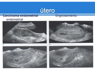 Carcinoma endometrial Engrosamiento
endometrial
 