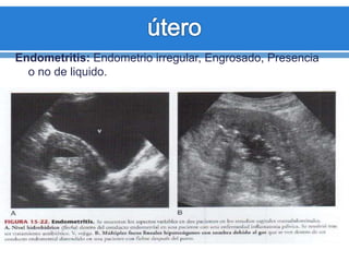 Endometritis: Endometrio irregular, Engrosado, Presencia
o no de liquido.
 