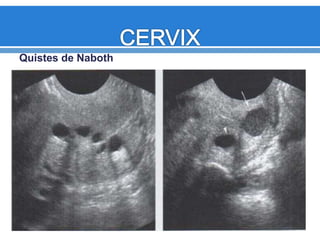 Quistes de Naboth
 