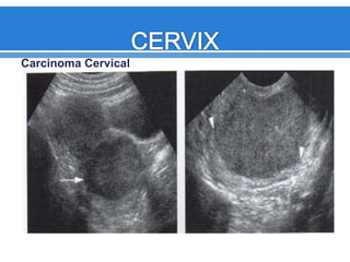 Carcinoma Cervical
 