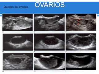 Quistes de ovarios
 