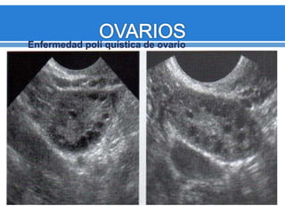 Enfermedad poli quística de ovario
 