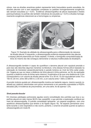 129
cóicos, mas as efusões anecóicas podem representar tanto transudatos quanto exsudatos. As
efusões pleurais com e sem septações complexas ou padrões homogeneamente ecogênicos
são sempre exsudatos (p < 0,01). Evidência ultrassonográfica de pleura espessada e lesões
parenquimatosas no pulmão são também indicativas de exsudato (p < 0,01) e efusões homoge-
neamente ecogênicas relacionam-se a hemorragias ou empiemas.
Figura 15: Exemplo da utilidade da ultrassonografia para a diferenciação da natureza
da efusão pleural. À esquerda, a ultrassonografia evidencia espessamento das pleuras
e espaço pleural preenchido por fluido septado. À direita, a tomografia computadorizada de
tórax do mesmo dia não conseguiu demonstrar a natureza multiloculada da efusão[27].
A ultrassonografia também é capaz de quantificar o derrame pleural com razoável precisão e
para isso são descritas algumas maneiras na literatura. Uma dessas formas [23] é baseada na
colocação do transdutor perpendicularmente à parede torácica ao nível da linha axilar poste-
rior. Sugere-se que se meça a distância da linha pleural à linha pulmonar, ao fim da expiração
(quando a distância entre as linhas seria máximo). A estimativa é de que uma distância de 3 mm
corresponderia a um volume de efusão pleural entre 15 a 30 ml; 10 mm equivaleriam entre 75 a
150 ml; 20 mm, entre 300 a 600 m; e 35 mm, a um volume entre 1.500 a 2.500 ml.
A punção torácica guiada por ultrassonografia mostrou-se bastante segura, mesmo quando re-
alizada por médicos intensivistas com pouco treinamento e em pacientes submetidos a PEEPs
elevadas [28]. A incidência de pneumotórax, em uma série, foi de apenas 1,3%.
Sinal pseudo-tissular
Em diversas patologias pulmonares agudas ocorre consolidação dos pulmões que toca a su-
perfície pleural em pelo menos 98,5% das vezes[29], o que permite a exploração confiável por
meio da ultrassonografia. O pulmão consolidado apresenta um aspecto ecogênico, com uma
aparência ultrassonográfica que lembra a do fígado (figura 16). Tal aspecto permanece cons-
tante durante o ciclo respiratório e não ocorre, portanto, o sinal do sinusóide quando se aplica a
ultrassonografia em modo M.
Apostila Ecotin_2012.indb 129 29/02/2012 09:03:07
 