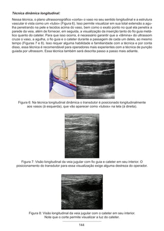 Técnica dinâmica longitudinal:
Nessa técnica, o plano ultrassonográfico «corta» o vaso no seu sentido longitudinal e a estrutura
vascular é vista como um «tubo» (Figura 6). Isso permite visualizar em sua total extensão a agu-
lha penetrando na pele e tecidos acima do vaso, bem como o exato ponto no qual ela penetra a
parede da veia, além de fornecer, em seguida, a visualização da inserção tanto do fio guia metá-
lico quanto do cateter. Para que isso ocorra, é necessário garantir que a «lâmina» do ultrassom
cruze o vaso, a agulha, o fio guia e o cateter durante a passagem de cada um deles, ao mesmo
tempo (Figuras 7 e 8). Isso requer alguma habilidade e familiaridade com a técnica e por conta
disso, essa técnica é recomendável para operadores mais experientes com a técnica de punção
guiada por ultrassom. Essa técnica também será descrita passo a passo mais adiante.
Figura 6: Na técnica longitudinal dinâmica o transdutor é posicionado longitudinalmente
aos vasos (à esquerda), que vão aparecer como «tubos» na tela (à direita).
Figura 7: Visão longitudinal da veia jugular com fio guia e cateter em seu interior. O
posicionamento do transdutor para essa visualização exige alguma destreza do operador.
Figura 8: Visão longitudinal da veia jugular com o cateter em seu interior.
Note que o corte permite visualizar a luz do cateter.
144
Apostila Ecotin_2012.indb 144 29/02/2012 09:03:11
 