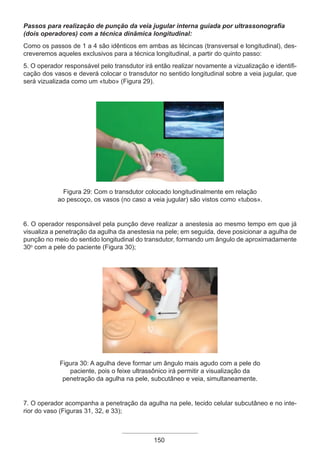 Passos para realização de punção da veia jugular interna guiada por ultrassonografia
(dois operadores) com a técnica dinâmica longitudinal:
Como os passos de 1 a 4 são idênticos em ambas as técincas (transversal e longitudinal), des-
creveremos aqueles exclusivos para a técnica longitudinal, a partir do quinto passo:
5. O operador responsável pelo transdutor irá então realizar novamente a vizualização e identifi-
cação dos vasos e deverá colocar o transdutor no sentido longitudinal sobre a veia jugular, que
será vizualizada como um «tubo» (Figura 29).
Figura 29: Com o transdutor colocado longitudinalmente em relação
ao pescoço, os vasos (no caso a veia jugular) são vistos como «tubos».
6. O operador responsável pela punção deve realizar a anestesia ao mesmo tempo em que já
visualiza a penetração da agulha da anestesia na pele; em seguida, deve posicionar a agulha de
punção no meio do sentido longitudinal do transdutor, formando um ângulo de aproximadamente
30o
com a pele do paciente (Figura 30);
Figura 30: A agulha deve formar um ângulo mais agudo com a pele do
paciente, pois o feixe ultrassônico irá permitir a visualização da
penetração da agulha na pele, subcutâneo e veia, simultaneamente.
7. O operador acompanha a penetração da agulha na pele, tecido celular subcutâneo e no inte-
rior do vaso (Figuras 31, 32, e 33);
150
Apostila Ecotin_2012.indb 150 29/02/2012 09:03:12
 