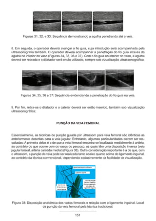 Figuras 31, 32, e 33: Sequência demonstrando a agulha penetrando até a veia.
8. Em seguida, o operador deverá avançar o fio guia, cuja introdução será acompanhada pela
ultrassonografia também. O operador deverá acompanhar a penetração do fio guia através da
agulha no interior do vaso (Figuras 34, 35, 36 e 37). Com o fio guia no interior do vaso, a agulha
deverá ser retirada e o dilatador será então utilizado, sempre sob vizualização ultrassonográfica.
Figuras 34, 35, 36 e 37: Sequência evidenciando a penetração do fio guia na veia.
9. Por fim, retira-se o dilatador e o cateter deverá ser então inserido, também sob vizualização
ultrassonográfica;
PUNÇÃO DA VEIA FEMORAL
Essencialmente, as técnicas de punção guiada por ultrassom para veia femoral são idênticas as
anteriormente descritas para a veia jugular. Entretanto, algumas particularidades devem ser res-
saltadas. A primeira delas é a de que a veia femoral encontra-se localizada medialmente à artéria,
ao contrário do que ocorre com os vasos do pescoço, os quais têm uma disposição inversa (veia
jugular lateral, artéria carótida medial) (Figura 38). Outra consideração importante é a de que, com
o ultrassom, a punção da veia pode ser realizada tanto abaixo quanto acima do ligamento inguinal,
ao contrário da técnica convencional, dependendo exclusivamente da facilidade de visualização.
Espinha Ilíaca S
uperior eAnterior
Ligamento Inguinal
VeiaFemoral
ArtériaFemoral
Nervo Femoral
Local de Punção
Femoral Tradicional
(Aproximadamente 1
cm abaixo do
ligamento inguinal)
Figura 38: Disposição anatômica dos vasos femorais e relação com o ligamento inguinal. Local
de punção da veia femoral pela técnica tradicional.
151
Apostila Ecotin_2012.indb 151 29/02/2012 09:03:13
 