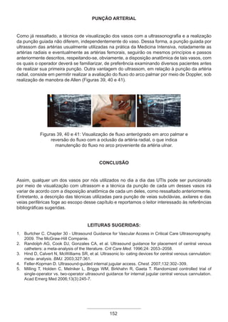 PUNÇÃO ARTERIAL
Como já ressaltado, a técnica de visualização dos vasos com a ultrassonografia e a realização
da punção guiada não diferem, independentemente do vaso. Dessa forma, a punção guiada por
ultrassom das artérias usualmente utilizadas na prática da Medicina Intensiva, notadamente as
artérias radiais e eventualmente as artérias femorais, seguirão os mesmos princípios e passos
anteriormente descritos, respeitando-se, obviamente, a disposição anatômica de tais vasos, com
os quais o operador deverá se familiarizar, de preferência examinando diversos pacientes antes
de realizar sua primeira punção. Outra vantagem do ultrassom, em relação à punção da artéria
radial, consiste em permitir realizar a avaliação do fluxo do arco palmar por meio de Doppler, sob
realização de manobra de Allen (Figuras 39, 40 e 41).
Figuras 39, 40 e 41: Visualização de fluxo anterógrado em arco palmar e
reversão do fluxo com a oclusão da artéria radial, o que indica
manutenção do fluxo no arco proveniente da artéria ulnar.
Conclusão
Assim, qualquer um dos vasos por nós utilizados no dia a dia das UTIs pode ser puncionado
por meio de visualização com ultrassom e a técnica da punção de cada um desses vasos irá
variar de acordo com a disposição anatômica de cada um deles, como ressaltado anteriormente.
Entretanto, a descrição das técnicas utilizadas para punção de veias subclávias, axilares e das
veias periféricas foge ao escopo desse capítulo e reportamos o leitor interessado às referências
bibliográficas sugeridas.
Leituras Sugeridas:
1. Burtcher C. Chapter 30 - Ultrasound Guidance for Vascular Access in Critical Care Ultrasonography.
2009. The McGraw-Hill Companie.
2. Randolph AG, Cook DJ, Gonzales CA, et al. Ultrasound guidance for placement of central venous
catheters: a meta-analysis of the literature. Crit Care Med. 1996;24: 2053–2058.
3. Hind D, Calvert N, McWilliams SR, et al. Ultrasonic lo- cating devices for central venous cannulation:
meta- analysis. BMJ. 2003;327:361.
4. Feller-Kopman D. Ultrasound-guided internal jugular access. Chest. 2007;132:302–309.
5. Milling T, Holden C, Melniker L, Briggs WM, Birkhahn R, Gaeta T. Randomized controlled trial of
single-operator vs. two-operator ultrasound guidance for internal jugular central venous cannulation.
Acad Emerg Med 2006;13(3):245-7.
152
Apostila Ecotin_2012.indb 152 29/02/2012 09:03:13
 