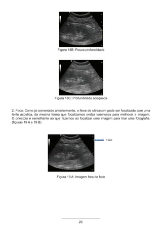 20
Figura 18B: Pouca profundidade
Figura 18C: Profundidade adequada
2. Foco: Como já comentado anteriormente, o feixe de ultrassom pode ser focalizado com uma
lente acústica, da mesma forma que focalizamos ondas luminosas para melhorar a imagem.
O princípio é semelhante ao que fazemos ao focalizar uma imagem para tirar uma fotografia.
(figuras 19 A e 19 B)
Foco
Figura 19 A: Imagem fora de foco
Apostila Ecotin_2012.indb 20 29/02/2012 09:02:56
 