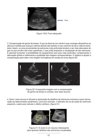 21
Foco
Figura 19 B: Foco adequado
3. Compensação de ganho de tempo: O que se deve ter em mente é que a energia ultrassônica se
atenua à medida que avança e retorna através dos tecidos no seu caminho de ida e volta ao trans-
dutor. Assim, os ecos provenientes da estruturas mais profundas tendem a ser mais atenuados do
que os que provêm das mais superficiais, o que pode prejudicar a vizualização de tais estruturas.
É possível aumentar a sensibilidade do equipamento aos ecos mais profundos, compensando a
atenuação sofrida e melhorando a qualidade das imagens correspondentes. O objetivo é ajustar a
compensação para obter uma imagem homogênea em escala de cinza (figura 20)
Figura 20: À esquerda imagem com a compensação
de ganho de tempo e à direita, sem esse recurso.
4. Zoom: esse recurso é útil para a apreciação de detalhes de estruturas menores e para mensu-
ração de determinados parâmetros, como por exemplo, o diâmetro da via de saída do ventrículo
esquerdo, usado para calcular o débito cardíaco. (figura 21)
Figura 21: O zoom é um recurso interessante
para apreciar detalhes das estruturas vizualizadas
Apostila Ecotin_2012.indb 21 29/02/2012 09:02:56
 