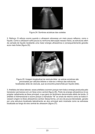 23
Figura 24: Sombras acústicas das costelas
2. Reforço: O reforço ocorre quando o ultrassom atravessa um meio pouco reflexivo, como o
líquido. Como o ultrassom sofre pouca ou nenhuma atenuação nesses meios, as estruturas além
da camada de líquido receberão uma maior energia ultrassônica e consequentemente gerarão
ecos mais fortes (figura 25)
Figura 25: Imagem longitudinal da vesícula biliar: as sobras acústicas são
provocadas por cálculos biliares e nota-se o reforço das estruturas
localizadas atrás da vesícula, que se encontra preenchida por líquido (bile).
3. Artefatos de lobos laterais: esses artefatos ocorrem porque nem toda a energia produzida pelo
transdutor permanece em um feixe único central (figura 26). Parte da energia ultrassônica irá se
projetar radialmente ao feixe principal, o que gera um fenômeno denominado efeito de borda. O
artefato é tridimensional e ocorre porque o transdutor “lê” os sinais de retorno como se todos ti-
vessem origem no feixe ultrassônico central. Dessa forma, um eco de pouca intensidade, gerado
por uma estrutura localizada lateralmente ao alvo principal será mostrada como se estivesse
localizada ao longo do eixo central do ultrassom (figura 27).
Apostila Ecotin_2012.indb 23 29/02/2012 09:02:57
 