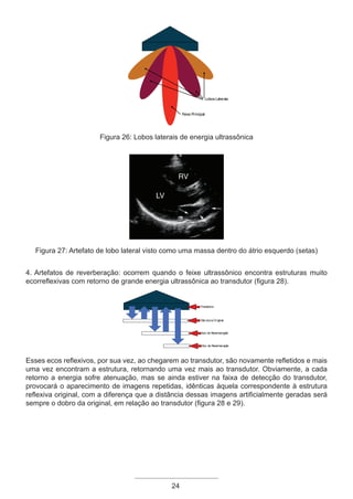 24
Feixe Principal
Lobos Laterais
Figura 26: Lobos laterais de energia ultrassônica
!
Figura 27: Artefato de lobo lateral visto como uma massa dentro do átrio esquerdo (setas)
4. Artefatos de reverberação: ocorrem quando o feixe ultrassônico encontra estruturas muito
ecorreflexivas com retorno de grande energia ultrassônica ao transdutor (figura 28).
Transdutor
Estrutura Original
Eco de Reverberação
Eco de Reverberação
Esses ecos reflexivos, por sua vez, ao chegarem ao transdutor, são novamente refletidos e mais
uma vez encontram a estrutura, retornando uma vez mais ao transdutor. Obviamente, a cada
retorno a energia sofre atenuação, mas se ainda estiver na faixa de detecção do transdutor,
provocará o aparecimento de imagens repetidas, idênticas àquela correspondente à estrutura
reflexiva original, com a diferença que a distância dessas imagens artificialmente geradas será
sempre o dobro da original, em relação ao transdutor (figura 28 e 29).
Apostila Ecotin_2012.indb 24 29/02/2012 09:02:57
 