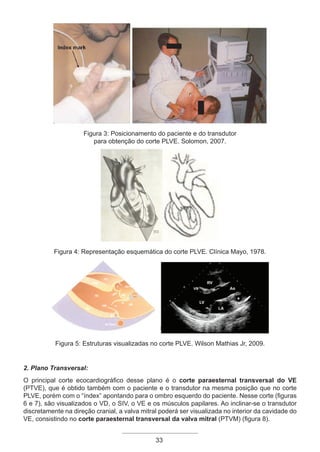 33
Figura 3: Posicionamento do paciente e do transdutor
para obtenção do corte PLVE. Solomon, 2007.
Figura 4: Representação esquemática do corte PLVE. Clínica Mayo, 1978.
Figura 5: Estruturas visualizadas no corte PLVE. Wilson Mathias Jr, 2009.
2. Plano Transversal:
O principal corte ecocardiográfico desse plano é o corte paraesternal transversal do VE
(PTVE), que é obtido também com o paciente e o transdutor na mesma posição que no corte
PLVE, porém com o “índex” apontando para o ombro esquerdo do paciente. Nesse corte (figuras
6 e 7), são visualizados o VD, o SIV, o VE e os músculos papilares. Ao inclinar-se o transdutor
discretamente na direção cranial, a valva mitral poderá ser visualizada no interior da cavidade do
VE, consistindo no corte paraesternal transversal da valva mitral (PTVM) (figura 8).
Apostila Ecotin_2012.indb 33 29/02/2012 09:02:58
 