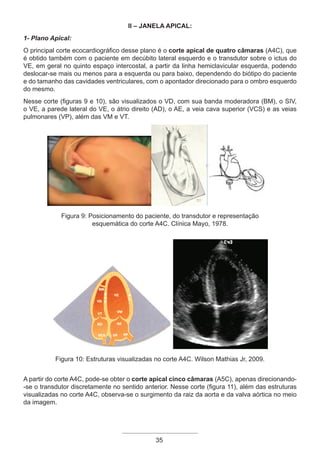 35
II – Janela Apical:
1- Plano Apical:
O principal corte ecocardiográfico desse plano é o corte apical de quatro câmaras (A4C), que
é obtido também com o paciente em decúbito lateral esquerdo e o transdutor sobre o ictus do
VE, em geral no quinto espaço intercostal, a partir da linha hemiclavicular esquerda, podendo
deslocar-se mais ou menos para a esquerda ou para baixo, dependendo do biótipo do paciente
e do tamanho das cavidades ventriculares, com o apontador direcionado para o ombro esquerdo
do mesmo.
Nesse corte (figuras 9 e 10), são visualizados o VD, com sua banda moderadora (BM), o SIV,
o VE, a parede lateral do VE, o átrio direito (AD), o AE, a veia cava superior (VCS) e as veias
pulmonares (VP), além das VM e VT.
Figura 9: Posicionamento do paciente, do transdutor e representação
esquemática do corte A4C. Clínica Mayo, 1978.
Figura 10: Estruturas visualizadas no corte A4C. Wilson Mathias Jr, 2009.
A partir do corte A4C, pode-se obter o corte apical cinco câmaras (A5C), apenas direcionando-
-se o transdutor discretamente no sentido anterior. Nesse corte (figura 11), além das estruturas
visualizadas no corte A4C, observa-se o surgimento da raiz da aorta e da valva aórtica no meio
da imagem.
Apostila Ecotin_2012.indb 35 29/02/2012 09:02:59
 