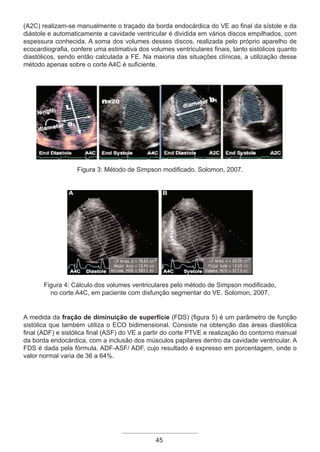 45
(A2C) realizam-se manualmente o traçado da borda endocárdica do VE ao final da sístole e da
diástole e automaticamente a cavidade ventricular é dividida em vários discos empilhados, com
espessura conhecida. A soma dos volumes desses discos, realizada pelo próprio aparelho de
ecocardiografia, confere uma estimativa dos volumes ventriculares finais, tanto sistólicos quanto
diastólicos, sendo então calculada a FE. Na maioria das situações clínicas, a utilização desse
método apenas sobre o corte A4C é suficiente.
Figura 3: Método de Simpson modificado. Solomon, 2007.
Figura 4: Cálculo dos volumes ventriculares pelo método de Simpson modificado,
no corte A4C, em paciente com disfunção segmentar do VE. Solomon, 2007.
A medida da fração de diminuição de superfície (FDS) (figura 5) é um parâmetro de função
sistólica que também utiliza o ECO bidimensional. Consiste na obtenção das áreas diastólica
final (ADF) e sistólica final (ASF) do VE a partir do corte PTVE e realização do contorno manual
da borda endocárdica, com a inclusão dos músculos papilares dentro da cavidade ventricular. A
FDS é dada pela fórmula, ADF-ASF/ ADF, cujo resultado é expresso em porcentagem, onde o
valor normal varia de 36 a 64%.
Apostila Ecotin_2012.indb 45 29/02/2012 09:02:59
 