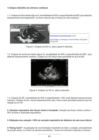 65
1.Colapso diastólico de câmaras cardíacas
1.1. Colapso do átrio direito (figura 4): sensibilidade de 55% e especificidade de 88% para detectar
tamponamento (principalmente se durar mais do que um terço do ciclo cardíaco).
Figura 4. Colapso do AD no plano apical 4 câmaras.
1.2. Colapso do ventrículo direito (figura 5): sensibilidade de 48% e especificidade de 88% para
detectar tamponamento cardíaco. Colapso do VD indica maior gravidade do que do AD.
Figura 5. Colapso do VD no plano subcostal.
1.3. Colapso do AE: sensibilidade de 25% e especificidade > 95% para detectar tamponamento
cardíaco. Colapso do AE, menos frequentemente visto, indica maior gravidade ainda do que em
relação ao do VD.
2. Variação respiratória dos fluxos mitral e tricúspide: redução dos fluxos mitral e aórtico >
25% durante a inspiração espontânea.
3. Dilatação e/ou redução < 50% da variação inspiratória do diâmetro da veia cava inferior
4.”Swing heart”: visualização de movimentação importante de todo o coração, principalmente
da porção apical, no interior do derrame pericárdico. Ocorre em derrame moderado a extenso.
Apostila Ecotin_2012.indb 65 29/02/2012 09:03:01
 