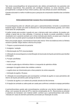 66
Tais sinais ecocardiográficos de tamponamento são válidos principalmente nos pacientes sob
ventilação espontânea. Nos pacientes sob ventilação mecânica, os sinais descritos acima,
principalmente a variação do fluxo mitral e aórtico, são mais difíceis de serem identificados.
A janela subcostal é a melhor incidência para a pesquisa de compressão diastólica das cavidades
direitas.
Pericardiocentese guiada pelo ecocardiograma
O ecocardiograma pode ser utilizado para guiar a pericardiocentese, tornando o procedimento
bastante seguro. Existe uma série na literatura de 1120 pericardiocenteses guiadas, com índice
muito baixo de complicações.
A melhor janela para punção é aquela em que o derrame está mais evidente. As janelas sub-
-xifóide e apical são as mais utilizadas. O acúmulo de líquido na janela subxifóide é melhor
visualizado com o paciente sentado com o tórax inclinado para diante, ao passo que o líquido se
acumula mais na janela apical na posição de decúbito lateral esquerdo.
Para uma punção segura, recomenda-se haver pelo menos 10mm de distância entre os folhetos
visceral e parietal. Segue abaixo a técnica de punção:
1. Preparo e posicionamento do paciente
2. Analgesia / sedação
3. Monitorização da PVC (recomendado)
4. Utilização do ecocardiograma na identificação do local exato de líquido pericárdico para facilitar
a drenagem
5. Punção subxifóidea:
– mais comum
– incisão na pele alguns milímetros inferior e à esquerda do apêndice xifóide
– passagem da agulha abaixo das costelas e esterno
– a agulha deve ser direcionada para a face posterior do ombro esquerdo
– Inclinação da agulha: 30 graus
6. Utilização do ecocardiograma para acompanhar a entrada da agulha no saco pericárdico até
retorno de líquido pericárdico pela seringa de 20 ml
7. Conexão da agulha a um sistema de pressão através de três torneiras
8. A injeção de contraste ou salina pode ser usada para confirmar a entrada no espaço pericárdico
A pericardiocentese guiada pelo ecocardiograma constitui-se uma técnica bastante segura e
eficaz, com sucesso de cerca de 97% e taxa de complicações de 2%. Recomenda-se proceder
a cobertura do transdutor com material estéril. Lembrar que a pericardiocentese está contra-
-indicada em casos de derrame pericárdico provocado por dissecção de aorta.
Apostila Ecotin_2012.indb 66 29/02/2012 09:03:01
 