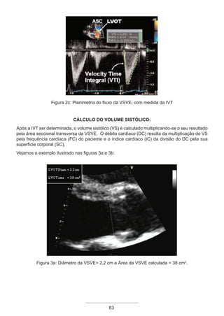 83
Figura 2c: Planimetria do fluxo da VSVE, com medida da IVT
CÁLCULO DO VOLUME SISTÓLICO:
Após a IVT ser determinada, o volume sistólico (VS) é calculado multiplicando-se o seu resultado
pela área seccional transversa da VSVE. O débito cardíaco (DC) resulta da multiplicação do VS
pela frequência cardíaca (FC) do paciente e o índice cardíaco (IC) da divisão do DC pela sua
superfície corporal (SC).
Vejamos o exemplo ilustrado nas figuras 3a e 3b:
Figura 3a: Diâmetro da VSVE= 2,2 cm e Área da VSVE calculada = 38 cm2
.
Apostila Ecotin_2012.indb 83 29/02/2012 09:03:03
 