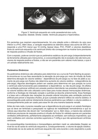 94
Figura 3: Ventrículo esquerdo em corte paraesternal eixo curto.
Esquerda: diástole. Direita: sístole. Ventrículo pequeno e hipercinético.
Em pacientes que respiram espontaneamente, há uma relação entre o diâmetro da veia cava
inferior e a PVC. Além disso, a variação respiratória do diâmetro dessa veia acima de 50% cor-
responde a uma PVC menor que 10 mmHg. Apesar disso, PVC, POAP, e volumes diastólicos
finais do ventrículo esquerdo e do ventrículo direito não conseguiram se mostrar bons previsores
de resposta positiva a infusão de fluidos.
Com o exposto, pode-se concluir que os parâmetros estáticos de pré-carga (independentemente
da ferramenta utilizada para mensurá-los, e a ecocardiografia não é exceção) não são bons pre-
visores de resposta positiva a fluidos, a não ser em pacientes com valores muito baixos, o que é
um achado relativamente raro.
Parâmetros Dinâmicos
Os parâmetros dinâmicos são utilizados para determinar se a curva de Frank Starling do pacien-
te encontra-se na sua fase ascendente (a elevação da pré-carga por meio de infusão de fluido
determina elevação do volume sistólico - dependência da pré-carga) ou na fase de platô (o au-
mento da pré-carga com fluidos não determina aumento do volume sistólico - independência da
pré-carga). Algumas abordagens podem ser usadas para determinar em que posição na curva
o ventrículo está funcionando para estabelecer a dependência ou não da pré-carga. Os efeitos
da ventilação pulmonar artificial com pressão positiva intermitente nas pressões intratorácicas e
no volume sistólico têm sido utilizados como base para muitas dessas mensurações dinâmicas,
conforme a fisiologia da interação coração e pulmões já descrita anteriormente. Essa fisiologia
é a base sob a utilização das variações da pressão arterial induzidas pela ventilação pulmonar
artificial para prever a resposta a fluidos, já que a pressão arterial é reflexo do volume sistólico. A
ecocardiografia pode estimar diretamente diversos parâmetros que refletem o volume sistólico e
consequentemente pode ser usado para esse fim de uma maneira bastante versátil.
Antes de mais nada, é preciso ressaltar que a dependência de pré-carga é um estado fisiológico
que só deve ser lembrado e pesquisado na vigência de instabilidade hemodinâmica e que os
índices aqui descritos não devem der “normalizados” por si. Além disso, a maioria das variáveis
dinâmicas previsoras de resposta positiva à infusão de fluidos foi validada apenas em pacientes
ventilados artificialmente, perfeitamente adaptados ao ventilador, sem esforços inspiratórios, que
eram ventilados com volumes correntes superiores a 7 ml/Kg e que não apresentavam arritmias
cardíacas.
As ecocardiografias transtorácica e transesofágica permitem medir as velocidades Doppler ao
nível da via de saída do ventrículo esquerdo e, consequentemente, o volume de ejeção sistólico.
A dimensão da via de saída do ventrículo esquerdo não varia durante o ciclo respiratório e pode
Apostila Ecotin_2012.indb 94 29/02/2012 09:03:04
 