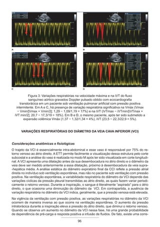 96
Figura 3: Variações respiratórias na velocidade máxima e na iVT do fluxo
sanguíneo aórtico gravados Doppler pulsado obtido com ecocardiografia
transtorácica em um paciente sob ventilação pulmonar artificial com pressão positiva
intermitente. Em A e C, há presença de variação respiratória significativa na Vmáx (Vmax
− Vmin/[Vmax + Vmin/2]; 1,29 − 1,09/1,19 = 17%) e na iVT (iVTmax − iVTmin/[iVTmax +
iVT min/2]; 20,7 − 17,3/19 = 18%). Em B e D, o mesmo paciente, após ter sido submetido a
expansão volêmica Vmáx (1,37 − 1,32/1,34 = 4%), iVT (23,5 − 22,3/22,9 = 5%).
Variações respiratórias do diâmetro da veia cava inferior (VCI)
Considerações anatômicas e fisiológicas
O trajeto da VCI é essencialmente intra-abdominal e esse vaso é responsável por 75% do re-
torno venoso ao átrio direito. A ETT permite facilmente a visualização dessa estrutura pelo corte
subcostal e a análise do vaso é realizada no modo M após ter sido visualizada em corte longitudi-
nal. A VCI apresenta uma dilatação antes da sua desembocadura no átrio direito e o diâmetro da
veia deve ser medido anteriormente a essa dilatação, próximo à desembocadura da veia supra-
-hepática média. A análise estática do diâmetro expiratório final da CCI reflete a pressão atrial
direita no indivíduo sob ventilação espontânea, mas não no paciente sob ventilação com pressão
positiva. Na ventilação espontânea, a variabilidade respiratória do diâmetro da VCI depende das
variações cíclicas da pressão pleural transmitidas ao átrio direito, as quais fazem variar periodi-
camente o retorno venoso. Durante a inspiração, o sangue é literalmente “aspirado” para o átrio
direito, o que ocasiona uma diminuição do diâmetro da VCI. Em contrapartida, a ausência de
variação respiratória no diâmetro da VCI indica, geralmente, que a pressão venosa está elevada.
Na vigência da ventilação com pressão positiva, as variações respiratórias no diâmetro da VCI
ocorrem de maneira inversa ao que ocorre na ventilação espontânea. O aumento da pressão
intratorácica durante a inspiração eleva a pressão do átrio direito, que diminui o retorno venoso.
Quando se observa um aumento no diâmetro da VCI nessa fase, há uma grande probabilidade
de dependência de pré-carga e resposta positiva a infusão de fluidos. De fato, existe uma corre-
Apostila Ecotin_2012.indb 96 29/02/2012 09:03:04
 